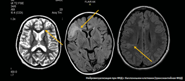 Кортикальная дисплазия на МРТ головного мозга