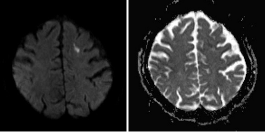 МРТ головного мозга. Определяется очаг ОНМК по ишемическому типу в левой лобной доле