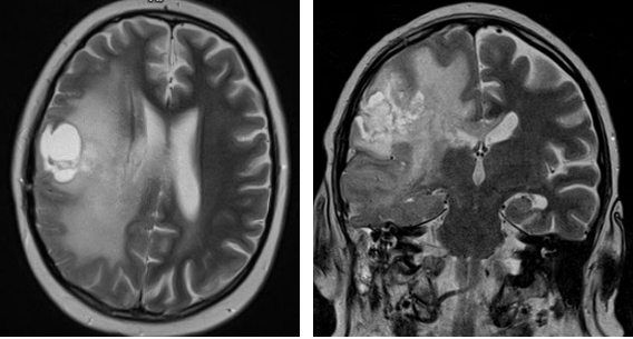 МРТ головного мозга показывает эпилепсию