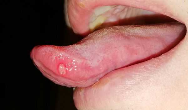 Язва на боковой поверхности языка