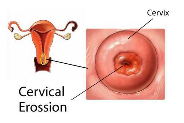 Истинная эрозия 
