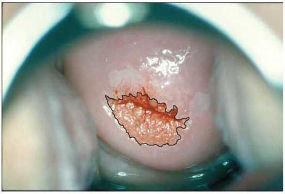 Эрозия шейки матки кольпоскопия﻿