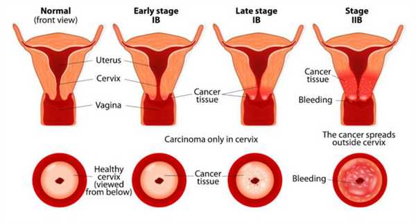 стадии эрозии шейки матки