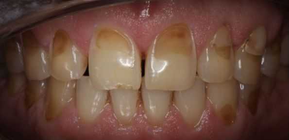 Разрушение эмали и дентина