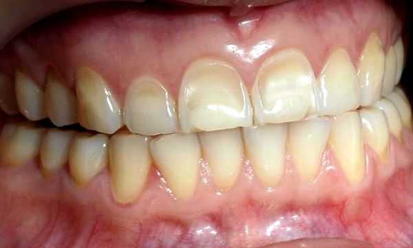 Потеря блеска и вогнутость эмали