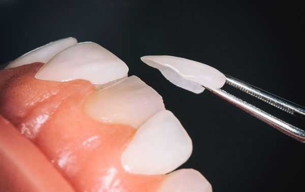 Установка винира