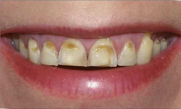 Изменения заметны во время улыбки