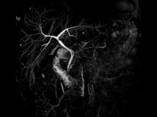 МР-холангиография с контрастом