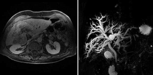 Холангиокарцинома на снимках МРТ