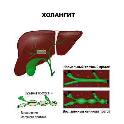 Холангит.jpg