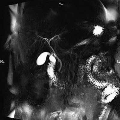 Томограмма желчевыводящих протоков