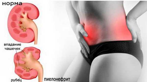 Боли в спине и пояснице у женщины