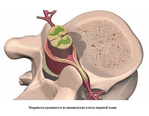 Невринома развивается из шванновских клеток нервной ткани