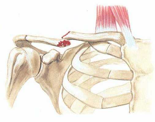 Перелом ключицы