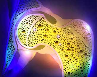 Остеопороз и его профилактика на фоне приема эндокринотерапии у пациентов в менопаузе при РМЖ