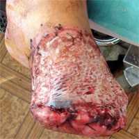 Состояние после резекции стопы