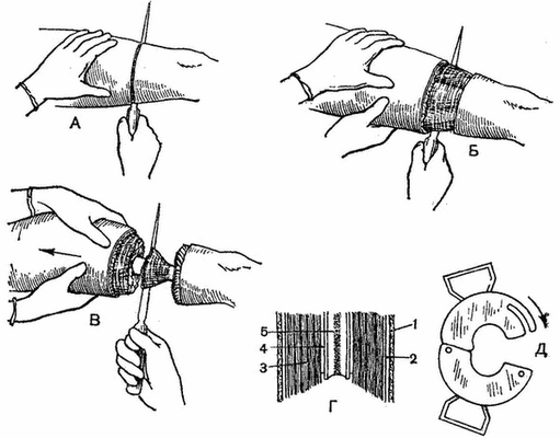 Круговое ампутирование
