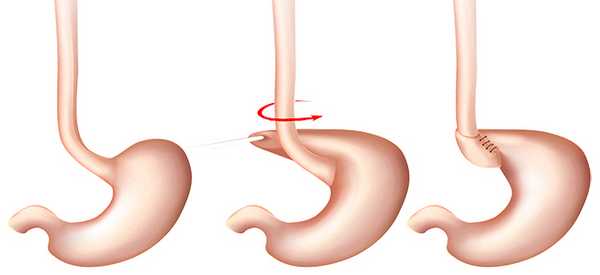 Фундопликация по Ниссену