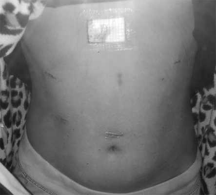 После Фундопликации