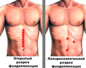 Фундопликация разрез