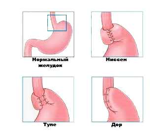 Методики фундопликации