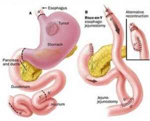 гастрэктомия