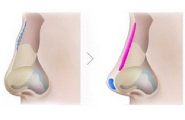 Микроринопластика - новое направление в пластике носа