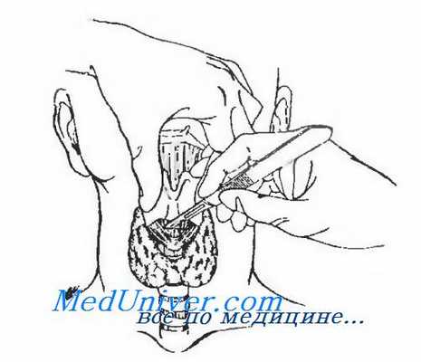 коникотомия - крикотиреоидотомия