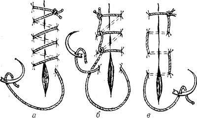 Рис. 8. Схематическое изображение простого (линейного) обвивного непрерывного шва и его вариантов: а — простой обвивной шов; б — обвивной шов по Мультановскому; в — матрацный шов.