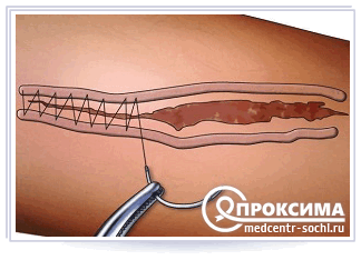 На какие раны накладывают вторичные медицинские швы