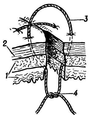 Рис. 5. Схематическое изображение наложения вворачивающего внутриузлового шва на стенку кишки по Пирогову — Матешуку: 1 — слизистая оболочка и мышечный слой стенки кишки; 2 — серозная оболочка кишки; 3 — шовная нить проведена через серозную и мышечную оболочки; 4 — узел формируют со стороны слизистой оболочки.