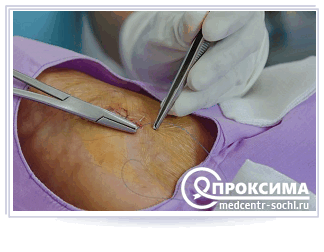 Процесс наложения вторичных швов