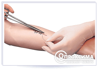 Снятие швов