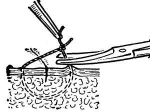Рис. 14. Схематическое изображение этапа снятия узлового кожного шва: потягиванием за узел на поверхность выведен находившийся под кожей участок нити, который пересекают ножницами.