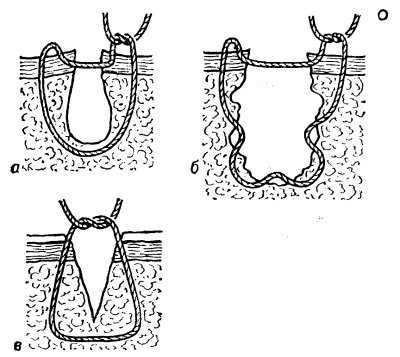 Рис. 7. Схематическое изображение вариантов узловых адаптирующих швов: а — П-образный (петлеобразный) шов по Донати; б — многостешковый обвивной шов по Стручкову и сотрудники; в — узловой адаптирующий шов по Джиллису.