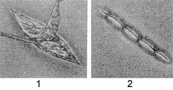 Рис. 2. Поздний вторичный шов: 1— иссечение краев и дна раны; 2 — вид раны после зашивания.