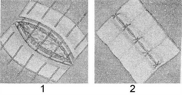Рис. 1. Сближение краев раны клеоловой повязкой: 1 — проведены нити через края клеоловой повязки; 2 — вид законченной повязки.