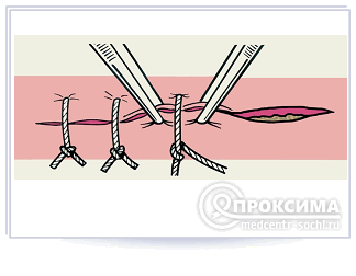 Наложение вторичных швов