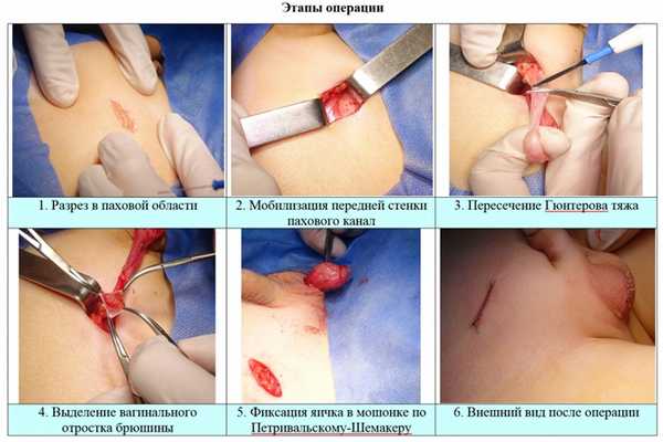 Этапы оперативного лечения крипторхизма, фото