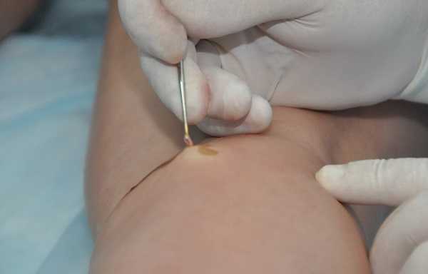 Как вена удаляется с помощью крючков