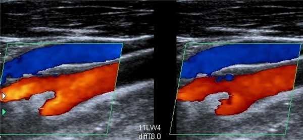 дуплексное УЗИ