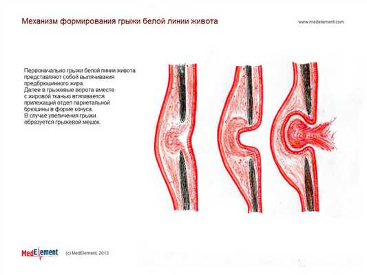 Механизм формирования грыжи белой линии живота