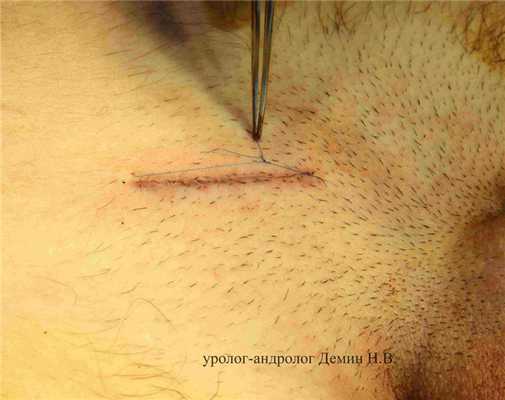 Яичко низведено в мошонку, фото