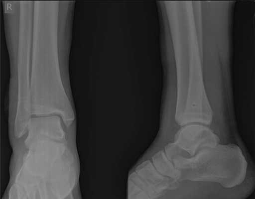 после операции на связках голеностопного сустава рентген