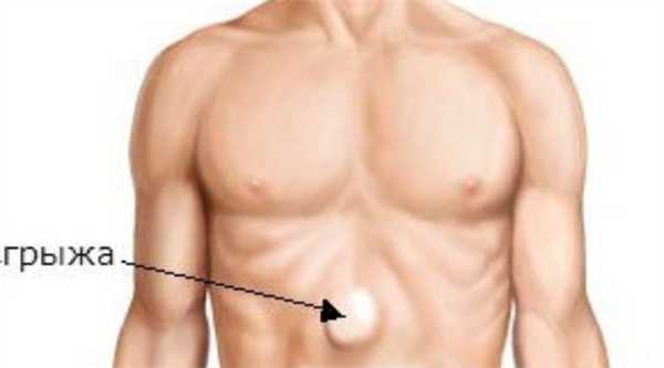 Грыжа белой линии живота