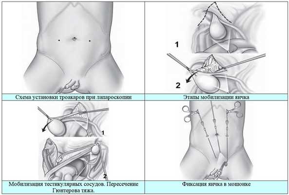 Лапароскопическое низведение яичка при крипторхизме, фото