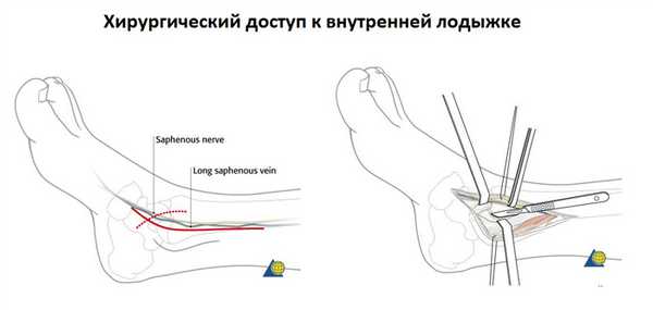 перелом внутренней лодыжки