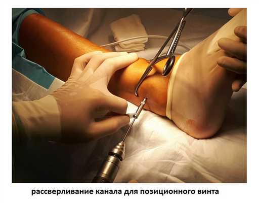 фиксация межберцового синдесмоза винтом