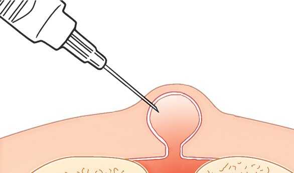 Удаление сухожильного ганглия, многопрофильная клиника МедПросвет