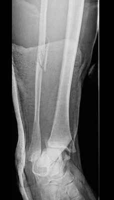 разрыв межберцового синдесмоза рентген